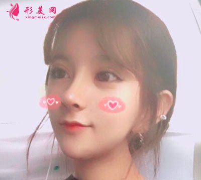 天津圣韓美醫(yī)療美容肋軟骨隆鼻案例