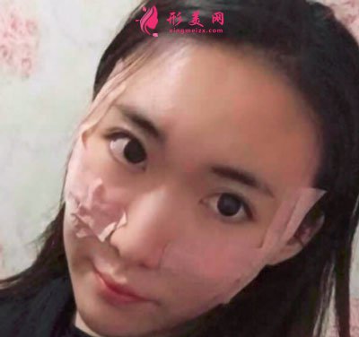 廈門安黛美醫(yī)療整形美容自體脂肪面填案例