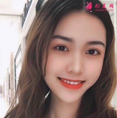 廈門安黛美醫(yī)療整形美容自體脂肪面填案例