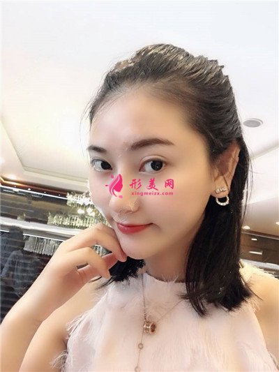 深圳耳軟骨隆鼻術(shù)后恢復情況對比