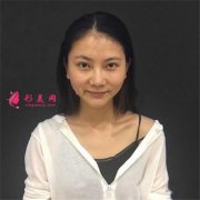 深圳富華耳軟骨隆鼻術(shù)后恢復(fù)情況對(duì)比