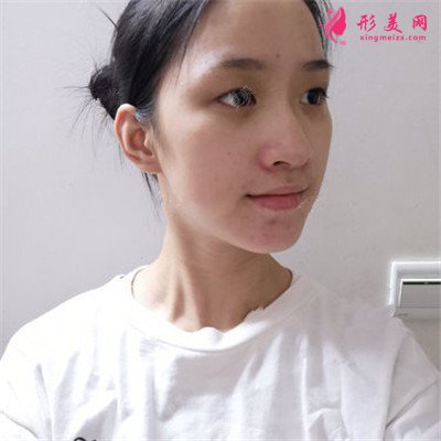 廈門小仙女全切雙眼皮術(shù)后恢復(fù)效果分享