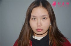長沙梵童醫(yī)療吸脂瘦臉術(shù)后恢復(fù)效果展示