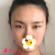 蘭州時光整形醫(yī)院眼綜合案例 眼睛的弧度很美