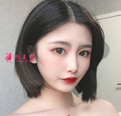 廣州星團(tuán)整形醫(yī)院的全切雙眼皮案例