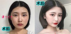 廣州星團(tuán)整形醫(yī)院的全切雙眼皮怎么樣？案例對(duì)比|價(jià)格|醫(yī)生