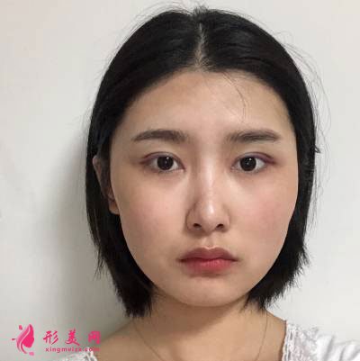 廣州星團(tuán)整形醫(yī)院的全切雙眼皮案例