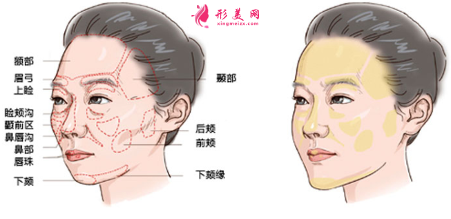 自體脂肪填充面部大約多少錢