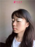 杭州同榮麗格小仙女切開雙眼皮術(shù)后恢復(fù)情況反饋
