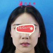 西安西美整形醫(yī)院下頜角磨骨案例分享 我也能成為美女了