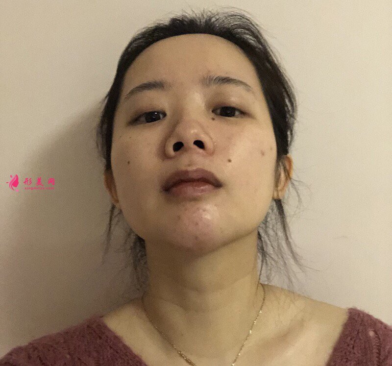 深圳富華曹夢君醫(yī)師真人案例 隆鼻110天前后對比圖分享
