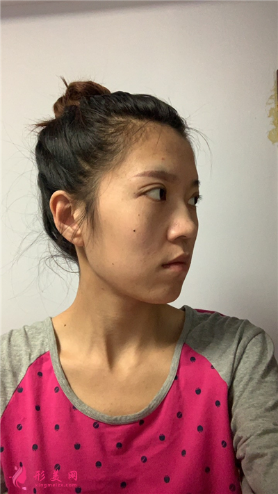 河南面部埋線提升術(shù)后效果分享