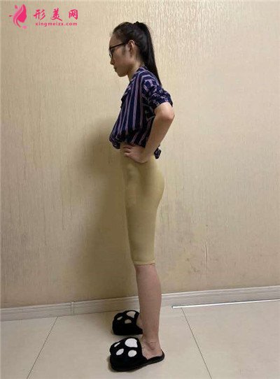 昆明小姐姐吸脂瘦大腿術(shù)后效果對比