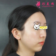 上海九院面部吸脂心得分享，消滅雙下巴，成就小V臉