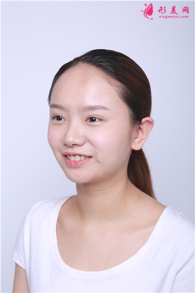 成都小姐姐種植發(fā)際線手術(shù)術(shù)后效果分享