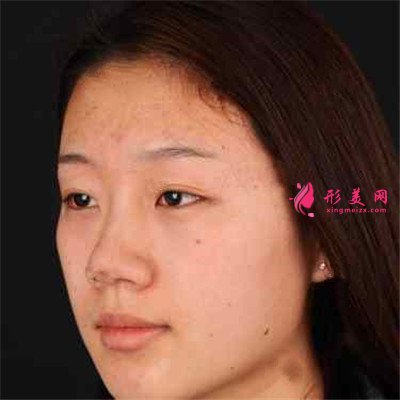 成都全切雙眼皮術(shù)后恢復(fù)效果展示