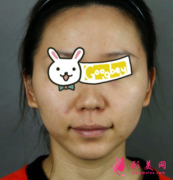 成都友誼醫(yī)院整形科顴骨內(nèi)推案例，大家都夸我漂亮