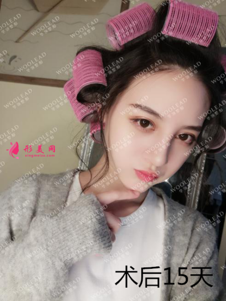 找鄭州華領(lǐng)朱志娟院長(zhǎng)做鼻綜合術(shù)后15天