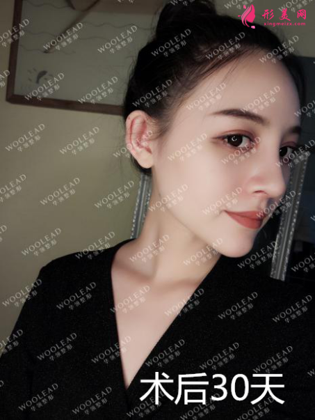 找鄭州華領(lǐng)朱志娟院長(zhǎng)做鼻綜合術(shù)后30天