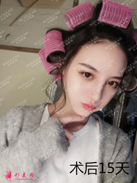 找鄭州華領(lǐng)朱志娟院長做鼻綜合術(shù)后15天