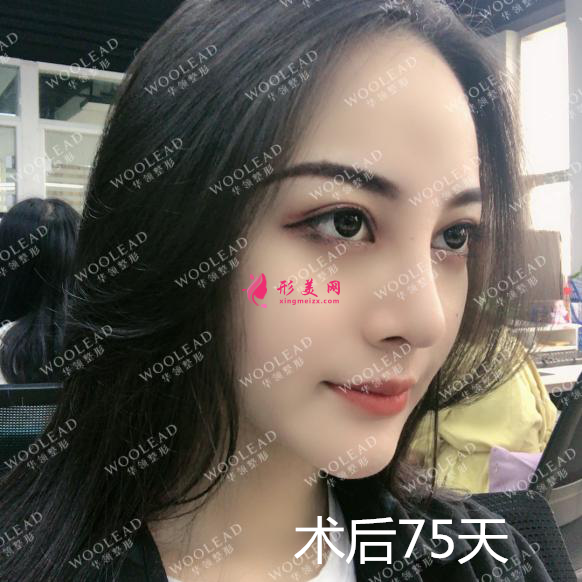 找鄭州華領(lǐng)朱志娟院長做鼻綜合術(shù)后75天