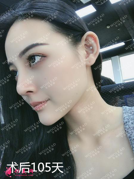 找鄭州華領(lǐng)朱志娟院長做鼻綜合術(shù)后105天