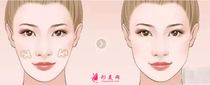 自體脂肪填充臉頰需要多少錢