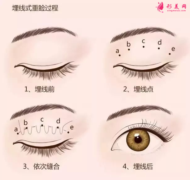 腫泡眼可以做埋線雙眼皮手術(shù)嗎