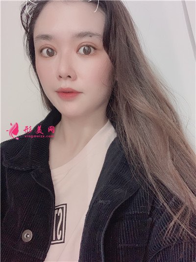南寧全切雙眼皮術(shù)后恢復(fù)情況對比