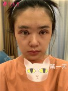 上海伯思立醫(yī)療美容全切雙眼皮術(shù)后恢復(fù)情況對比