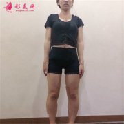 重慶軍美醫(yī)療整形水動(dòng)力吸脂瘦大腿恢復(fù)情況分享