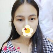 成都美容整形醫(yī)院全切雙眼皮效果分享 眼睛有靈氣了不少