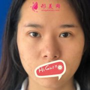 濟(jì)南伊美爾整形醫(yī)院鼻綜合案例，改變不止一點(diǎn)點(diǎn)