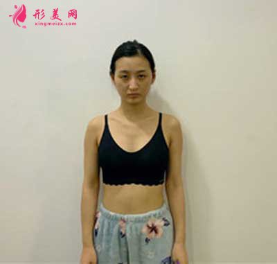 去廣州曙光整形美容醫(yī)院做假體隆胸手術(shù)前