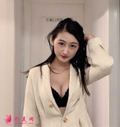 去廣州曙光整形美容醫(yī)院做假體隆胸手術(shù)后兩個(gè)月
