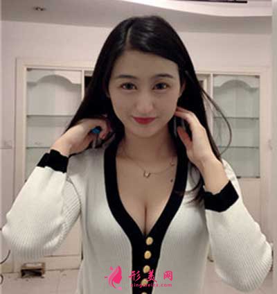 去廣州曙光整形美容醫(yī)院做假體隆胸手術(shù)后30天