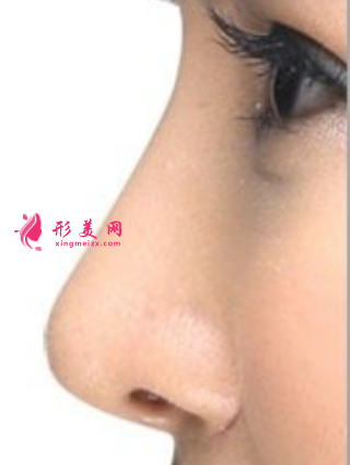 假體隆鼻術(shù)后多久可以恢復(fù)好