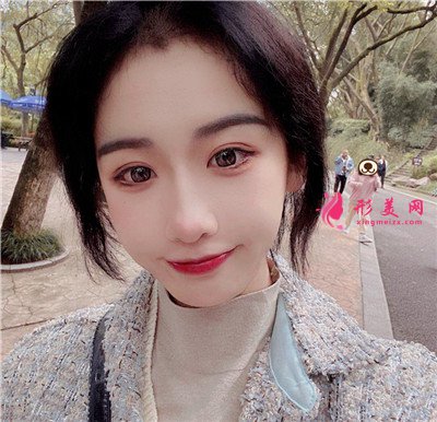 重慶埋線雙眼皮術(shù)后恢復(fù)效果對(duì)比