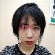 重慶軍科整形醫(yī)院埋線雙眼皮術(shù)后恢復效果對比