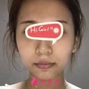 做熱瑪吉痛嗎？天津華美整形醫(yī)院熱瑪吉親身體驗