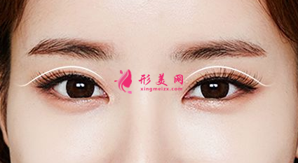 全切雙眼皮術(shù)后注意事項(xiàng)