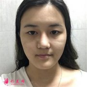 深圳富華醫(yī)療美容醫(yī)院全切雙眼皮術(shù)后恢復效果對比圖分享