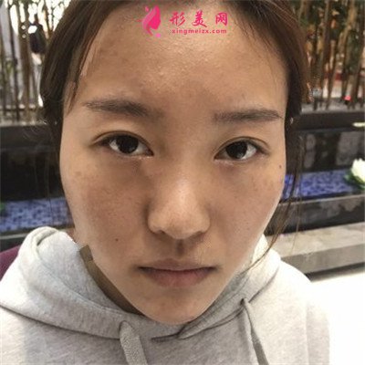 杭州肋軟骨隆鼻術(shù)后恢復(fù)情況對比