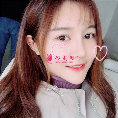 杭州肋軟骨隆鼻術(shù)后恢復(fù)情況對比