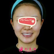 廣州廣大整形美容醫(yī)院熱瑪吉除皺真人案例 有點貴 但效果很值得