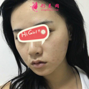 上海時(shí)光整形醫(yī)院下頜角磨骨真實(shí)案例 臉型變得好漂亮呀