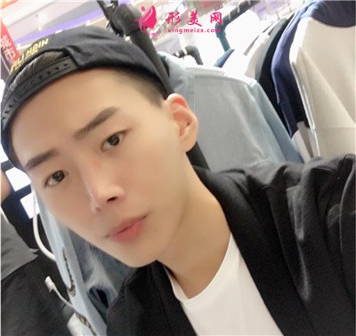 福州小哥哥鼻綜合術后恢復效果反饋