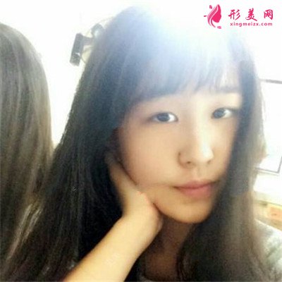 南昌切開雙眼皮術(shù)后恢復(fù)效果展示，小姐姐的模樣好標(biāo)致啊~