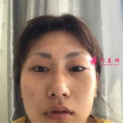北京潤(rùn)美玉之光醫(yī)療美容全切雙眼皮術(shù)后恢復(fù)效果展示