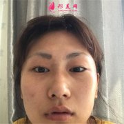 北京潤(rùn)美玉之光醫(yī)療美容全切雙眼皮術(shù)后恢復(fù)效果展示